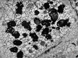 M,17y. | lipofuscin - hyperbilirubinaemia - Gilbert or Dubin-Johnson syndrome